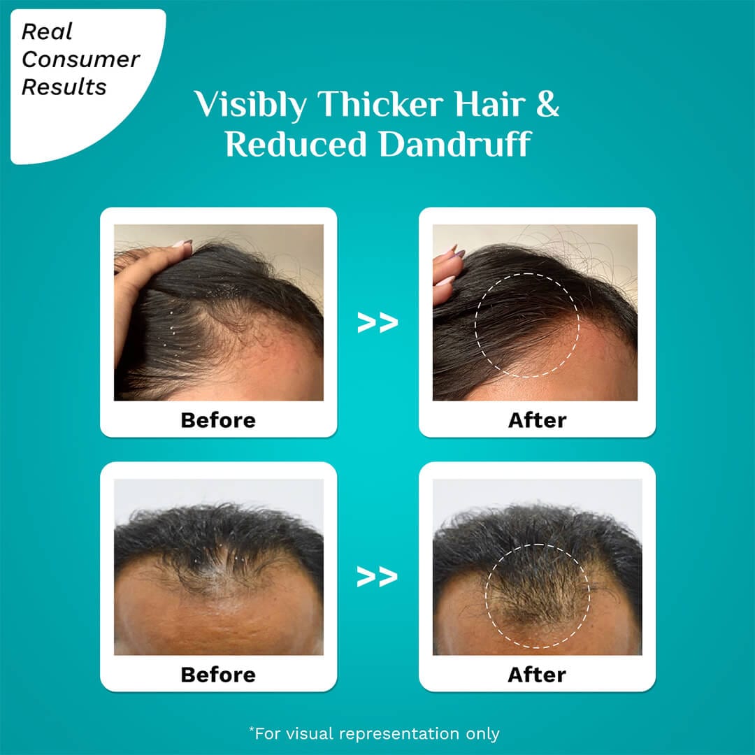 Advanced HGS For Dandruff Prone Scalp 30 ml 1080x1080 Real Consumer Results 1