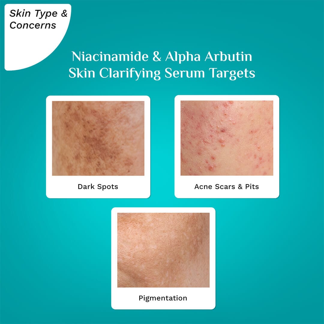 Niacinamide AlphaArbutinSkinClarifyingSerum 1080x1080 Skin Type Targets